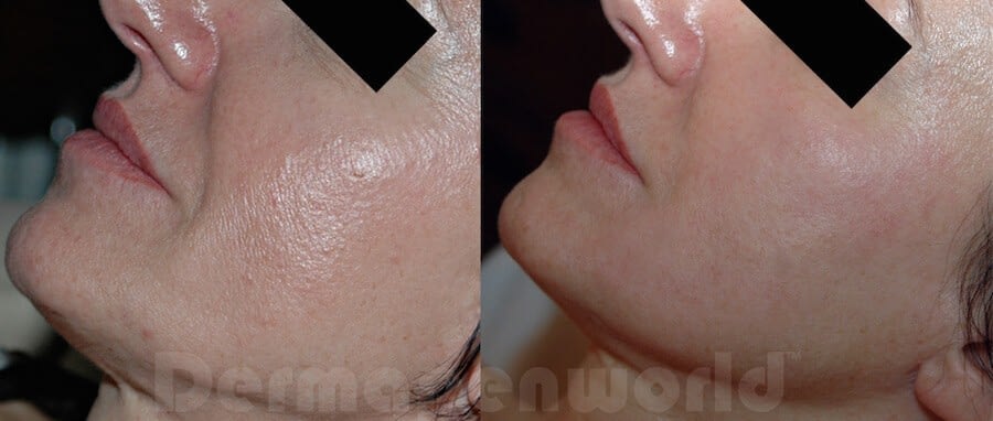 Removal of Skin Marks by Dr Genevieve Marks