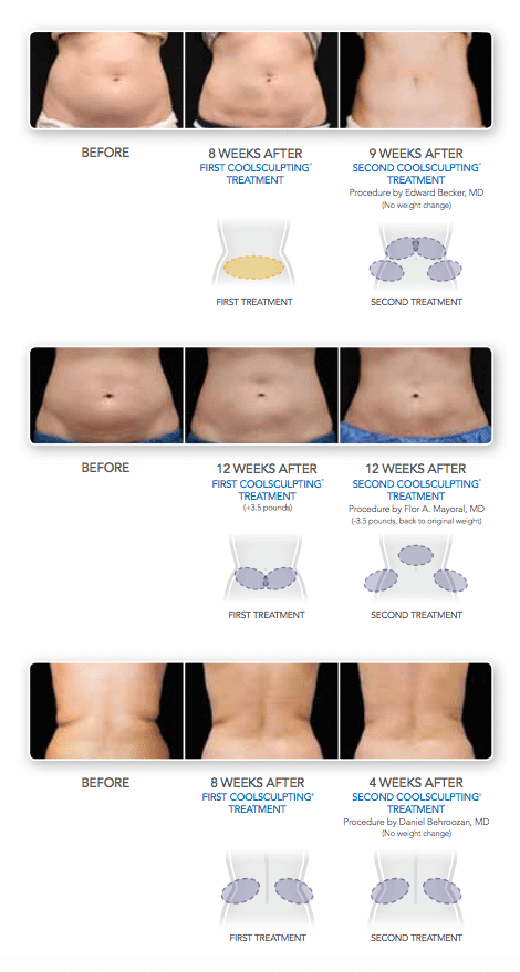 The body sculpting process available from Dr G Marks.