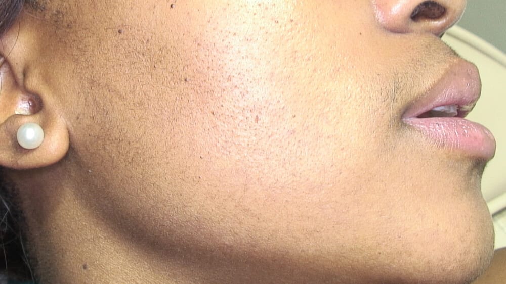 right cheek after treatment